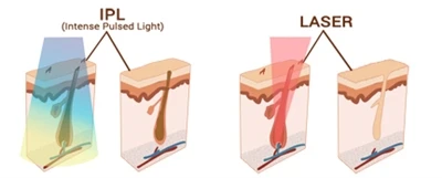 IPL vs. Laser: Nepotrebujú obaja rovnako prísne bezpečnostné opatrenia?
